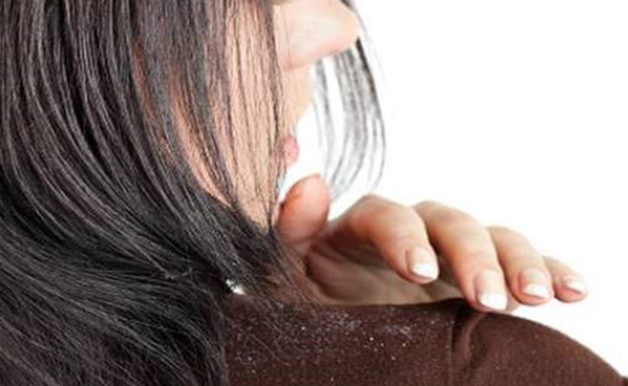 Lý Do Khiến Bạn Không Bao Giờ Hết Gàu?