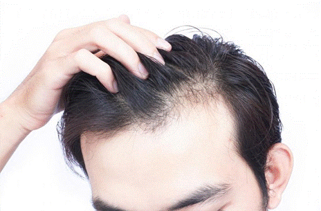 Top hơn 100 hình về tóc nam bị chởm  thuvientinhoceduvn