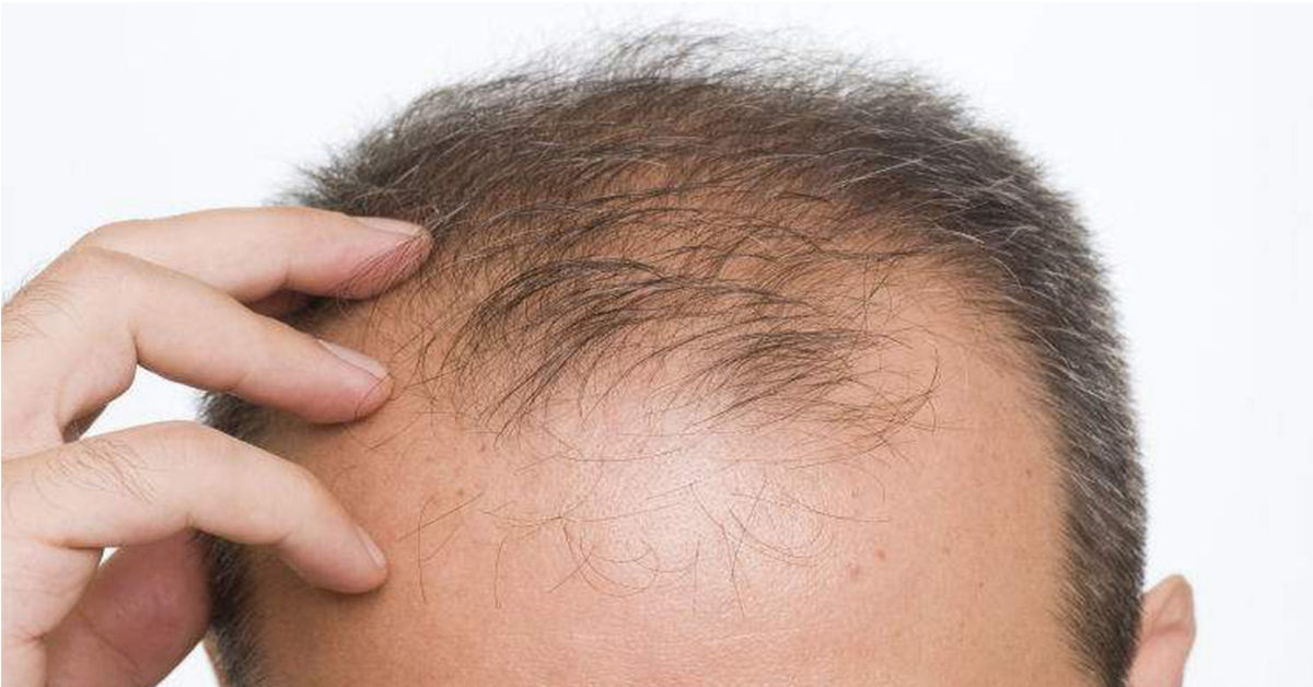 Không nên lạm dụng gel vuốt tóc sẽ dễ gây rụng tóc