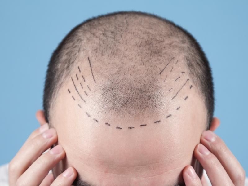 Hiện tượng rụng tóc nhiều của nam giới Nguyên nhân và cách khắc phục