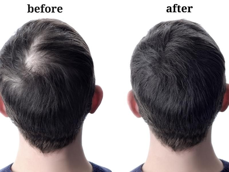 Những nguyên nhân gây rụng tóc ở nam giới và cách chữa trị